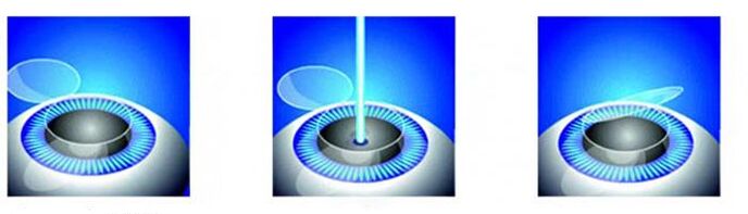 Stages of correction of laser vision
