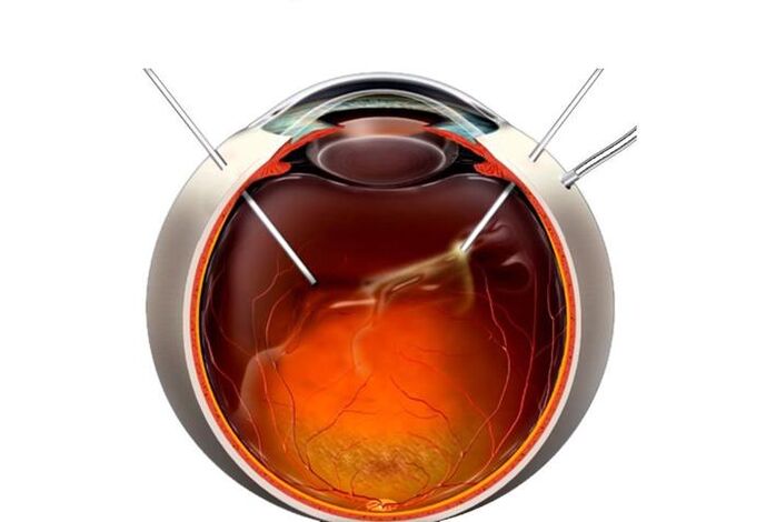 Vittectomy - Operation to restore vision